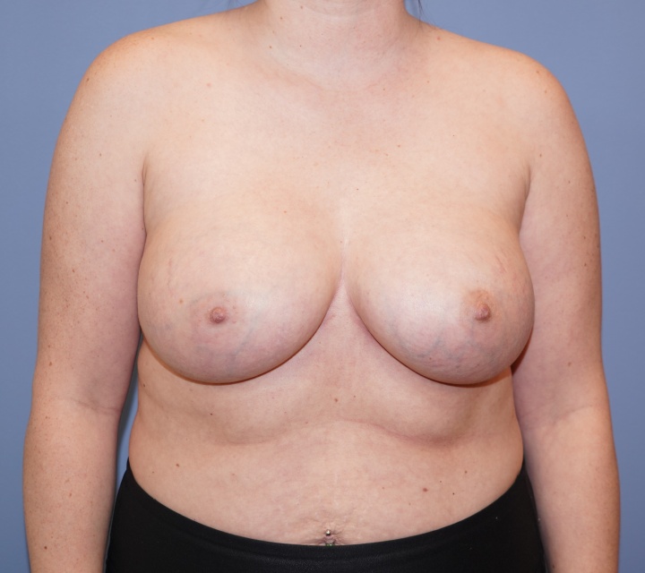 before and after breast augmentation