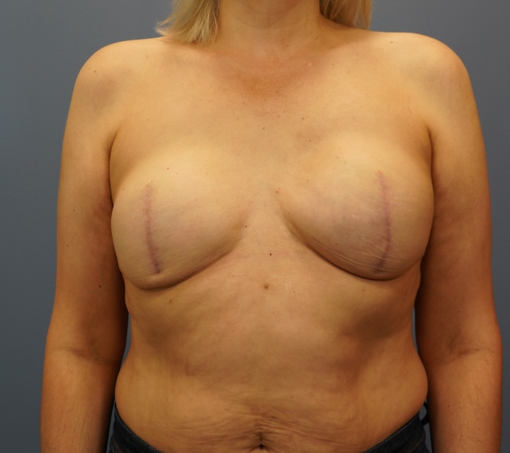 breast cancer reconstruction