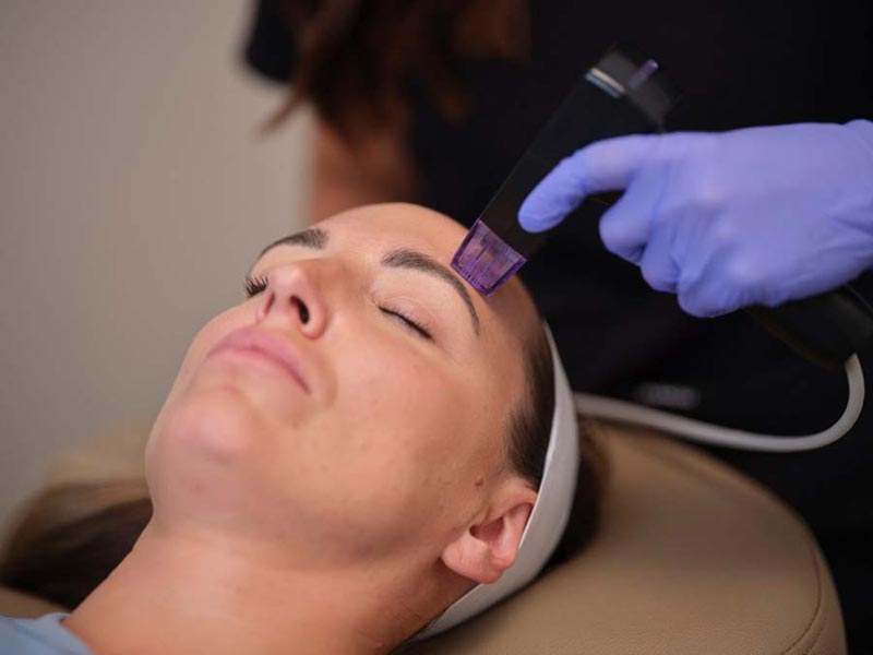 Azure--July22-202431051 microneedling treatment