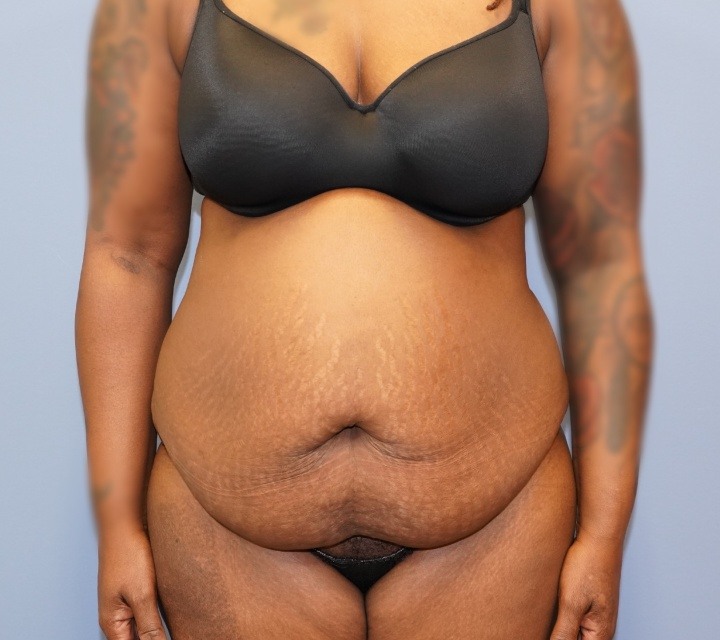 Abdominoplasty Before and After Surgery Gallery in Carmel, IN