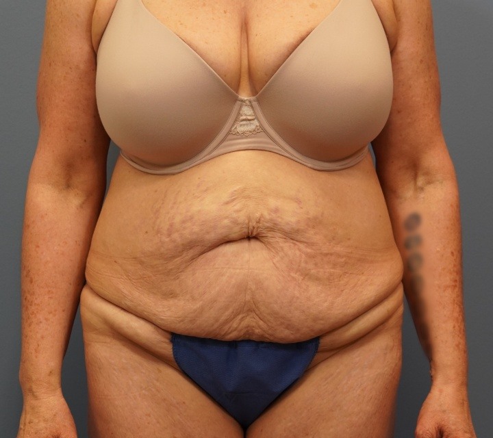 Abdominoplasty Before and After Treatment in Carmel, IN