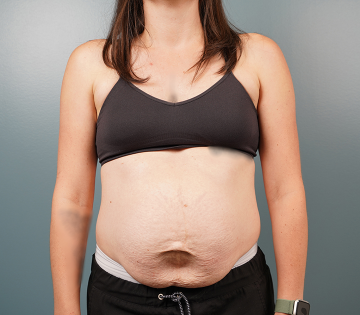 Before-Abdominoplasty