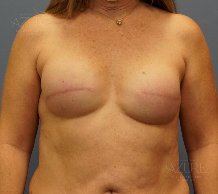 Close-up of breast reconstruction results after cancer treatment, Carmel,