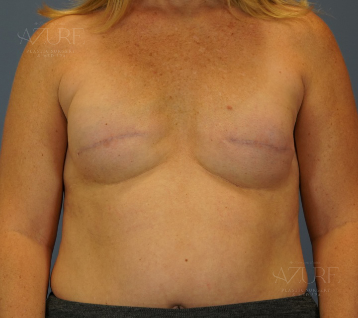 Patient showing breast reconstruction after cancer surgery, Carmel, IN